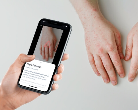 MVP of a computer vision-based app for skin disease monitoring - Teaser - Lemberg Solutions.jpg