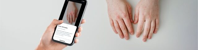MVP of a computer vision-based app for skin disease monitoring - Banner - Lemberg Solutions.jpg